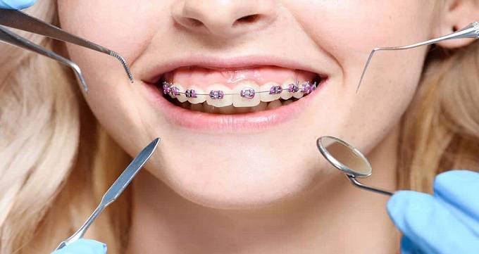 روش پزشکی سفید کردن دندان