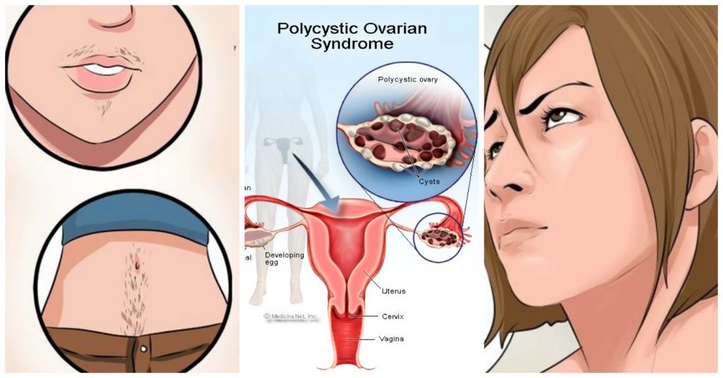 سندروم PCOS