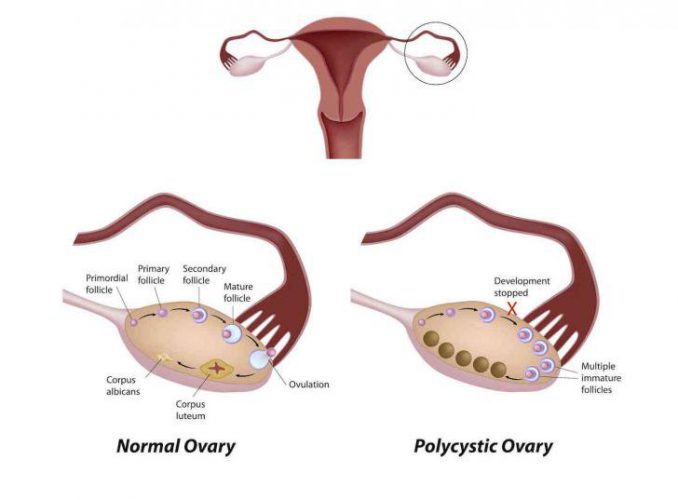 سندروم PCOS