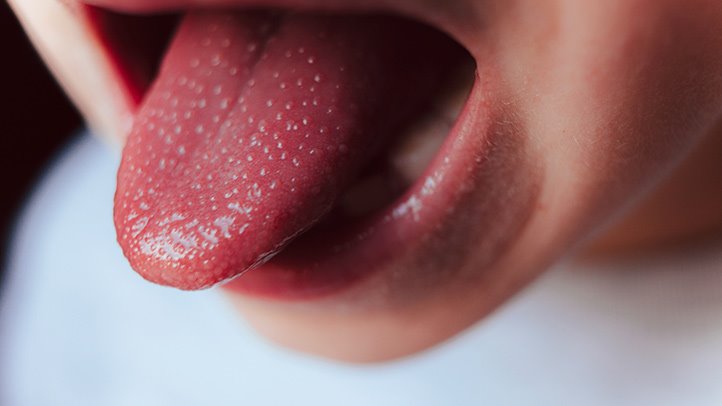 علائم بیماری کاوازاکی توت فرنگی شدن زبان