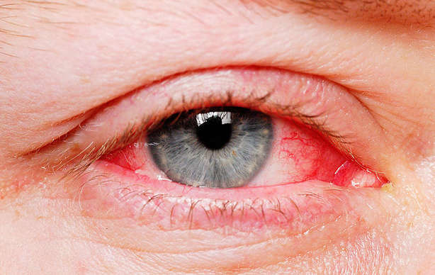 علائم بیماری کاوازاکی قرمزی چشم