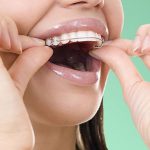 ارتودنسی متحرک