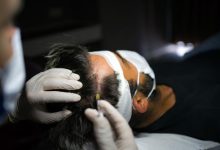 راهکارهای عملی برای تقویت مو بعد از کاشت