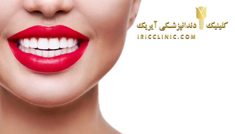 عکس لمینت دندان طرح لبخند