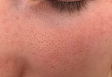 درمان منافظ پوست صورت