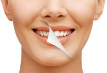 طول عمر لمینت دندان
