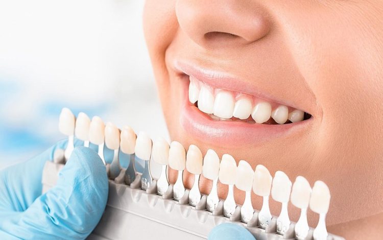 افزایش طول عمر لمینت دندان
