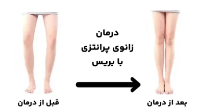 درمان زانو پرانتزی با بریس