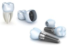 ایمپلنت امریکایی اینترالاک