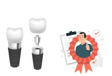 گارانتی ایمپلنت دندان