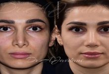 جراحی بینی طبیعی