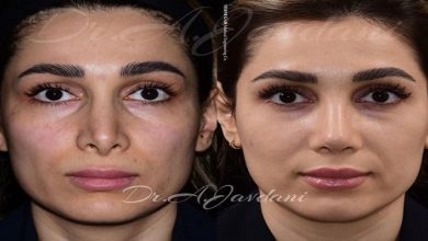 جراحی بینی طبیعی