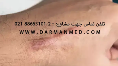 آنتی اسکار