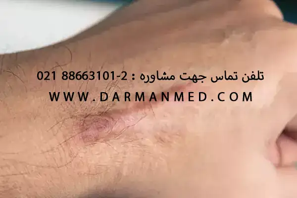 آنتی اسکار
