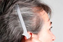 سفیدی موی کاشته شده از جمله دغدغه_های مطرح هنگام کاشت مو است