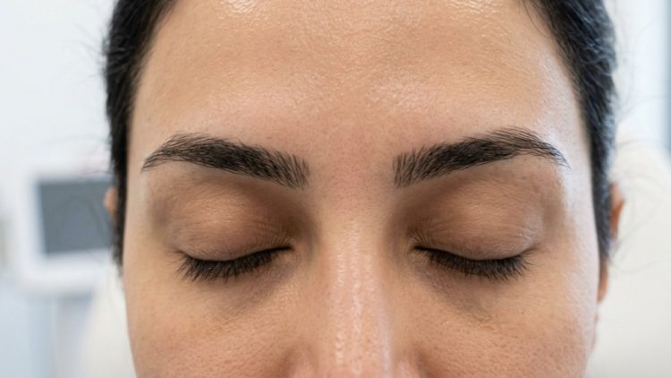 Forehead after frown line filler